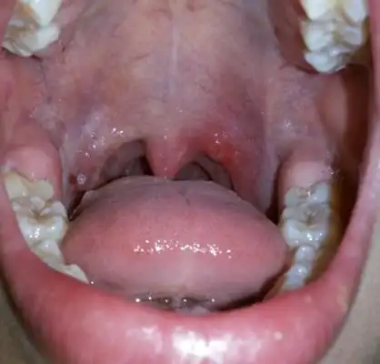 喉咙长了个囊肿图片77