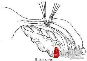 输卵管结扎术双侧