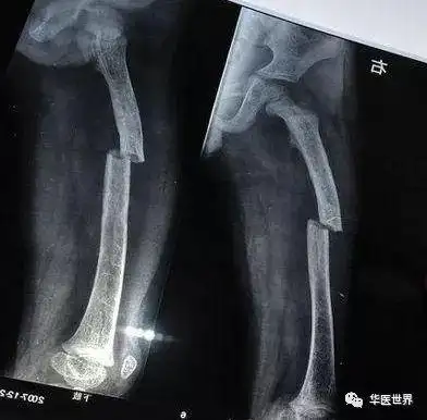 最疼的骨折骨折后走路脚脖子疼是怎么回事呢骨折的原因