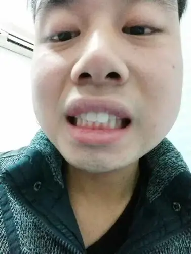 门牙有一颗比较突出,能整吗?要咋整,费用要多少