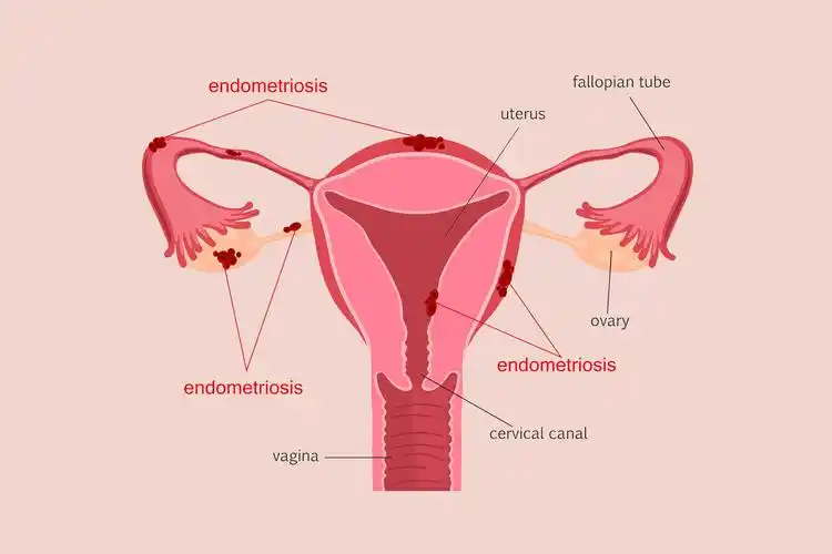 杭州菁华妇儿医院:子宫内膜"出轨"可致不孕_盆腔