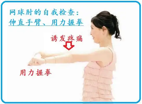 haodf:8:gongguwaishangkeyan-->网球肘 !