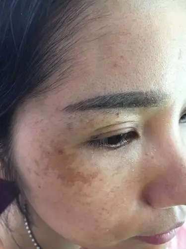 国家专利技术,解决雀斑,黄褐斑,真皮斑,色沉及痘坑痘痘13855519225