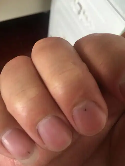 指甲上突然出现的黑点怎么回事?