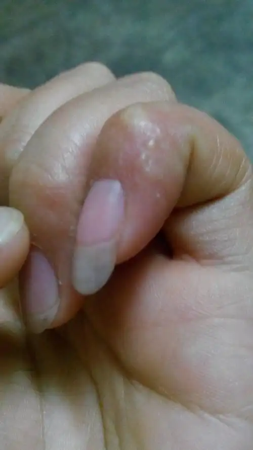 展开全部 问题分析: 你好,此情况为手癣,由致病性丝状真菌感染引起