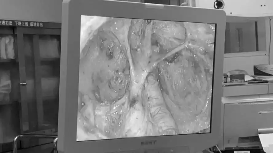 哈医大二院成功完成纳米碳导航下的外阴癌腹腔镜下腹股沟淋巴结清扫术