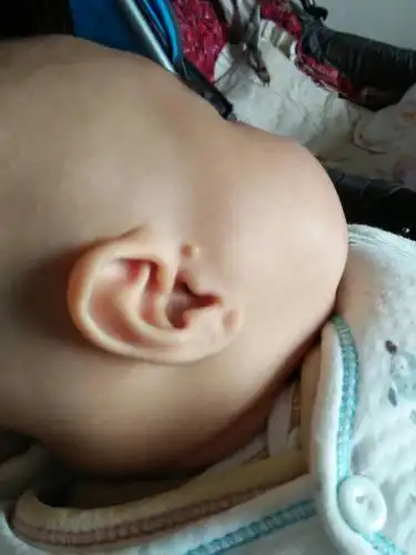 宝宝刚生下来耳朵上就有个拴马桩耳,现在宝宝三个月了,有什么办法可以