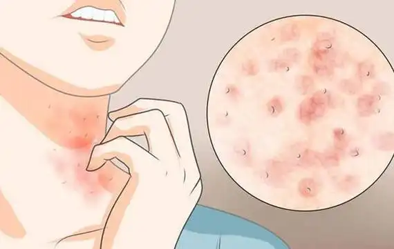 螨虫咬的包是啥样子,红疙瘩像丘疹(多成片出现很吓人)