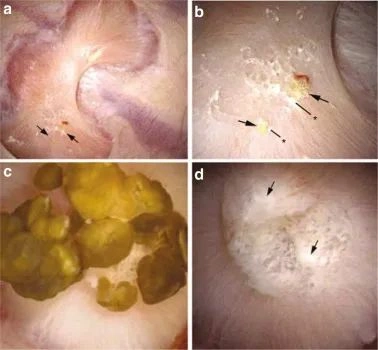 randalls 斑块(1):草酸钙肾结石的发病机制和作用|caox|高钙尿症|肾