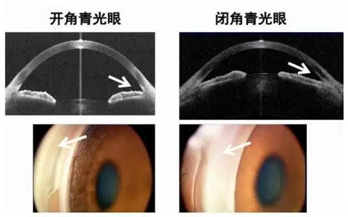 我国学者在闭角青光眼筛查与as-oct方面取得进展