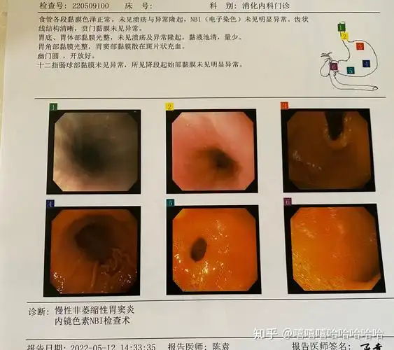 第一次无痛肠胃镜过程～不舒服一定要早点去检查! - 知乎