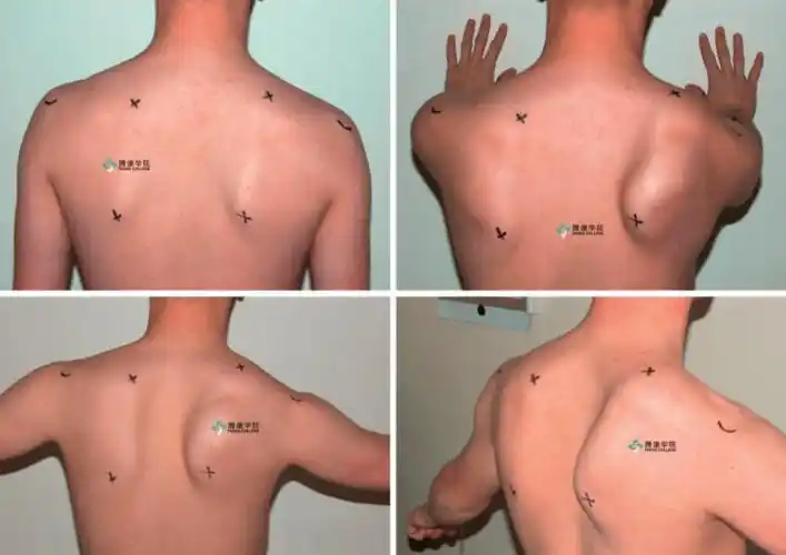 翼状肩原因分析汇总_肩胛骨