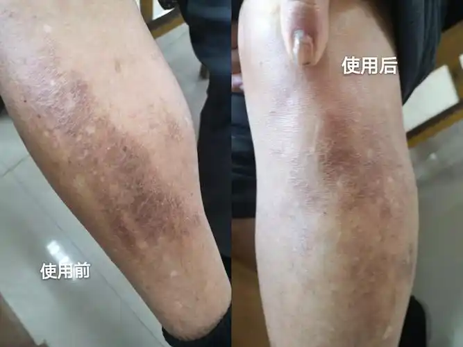 慢性湿疹苔藓化怎么处理