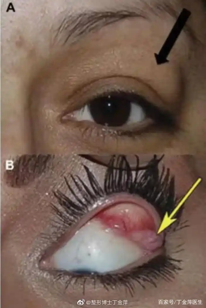 什么是泪腺脱垂?