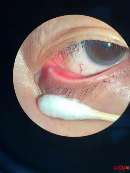 60岁婆婆眼角总是有眼屎一查竟是眼睛长了结石