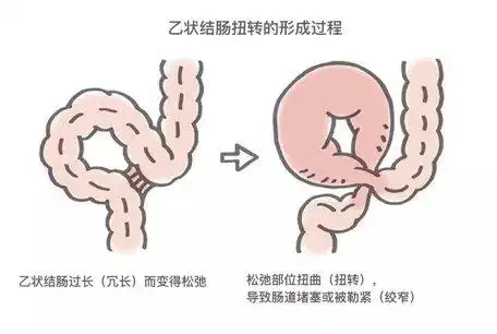来看看乙状结肠扭转!