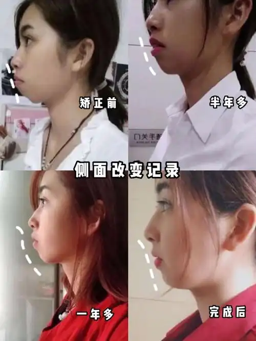 三年正畸Ⅰ轻度骨性凸嘴变化记录!