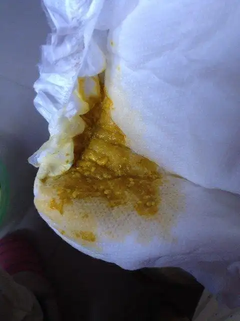 快两个月的宝宝拉这样的大便是属于消化不良吗?要怎么办啊!