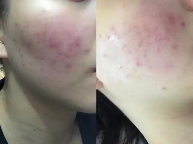 记录长痘过程对比