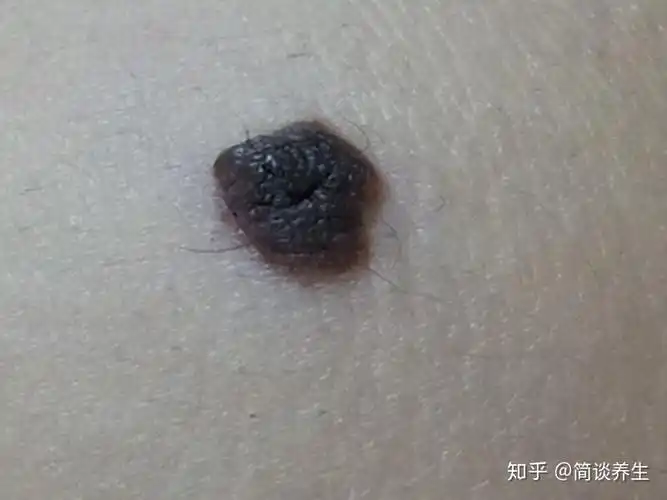 而恶痣的形状一般是不对称的.