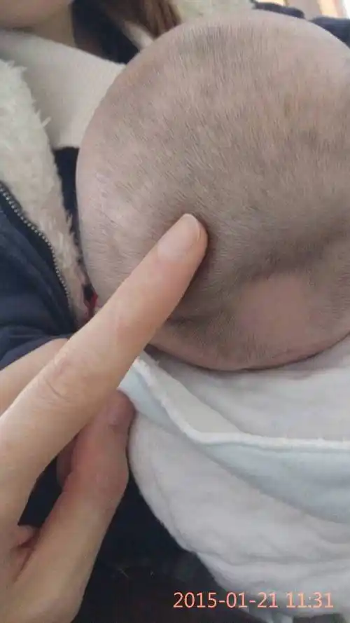 麻烦各位天使说一下,宝宝出生55天时(目前刚足两月),剃胎头后发现头顶