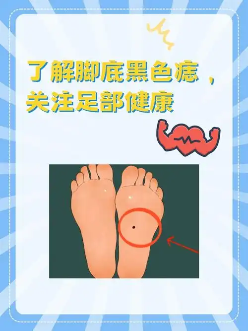 脚底长黑痣,到底要不要紧?