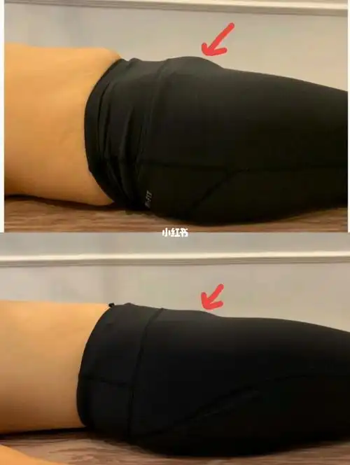 耻骨高不仅不美观还会影响盆底肌