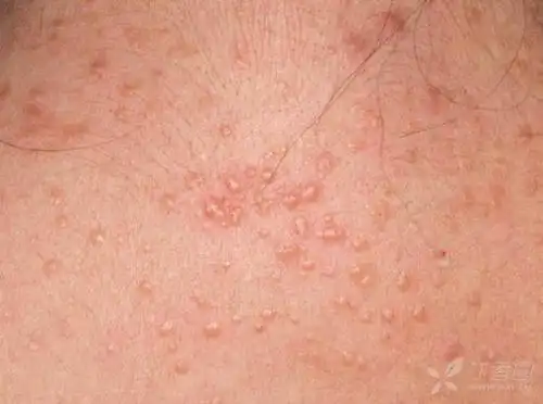 【看图识病】泛发丘疹1月,似有koebner同形现象 - 皮肤与性传播疾病