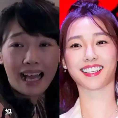 时尚 正文 还有白百合,左图是原本的牙齿,门牙有点大,还有虎牙,下排