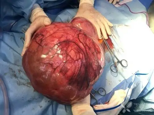 膨大如球的浆膜下子宫肌瘤(总觉得剖开之后,哪吒会跳出来)图片来自站