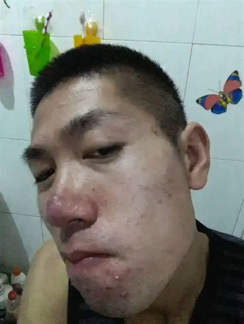 解压视频酒糟鼻