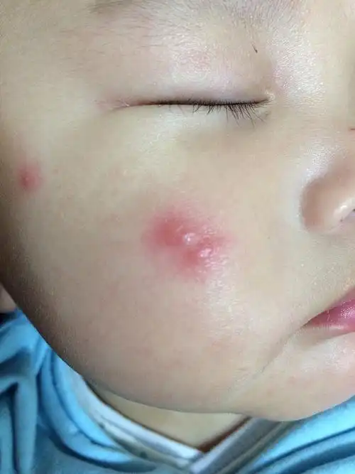 婴儿口水疹怎么办呢