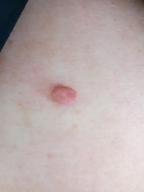 纤维瘤会被拒保吗 纤维瘤被保险公司拒赔