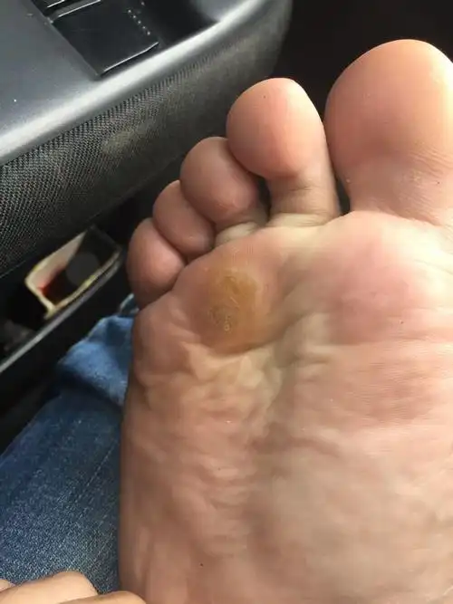 病时有8年左右了无传染,下崽现象.4年前做过一次手术切掉了