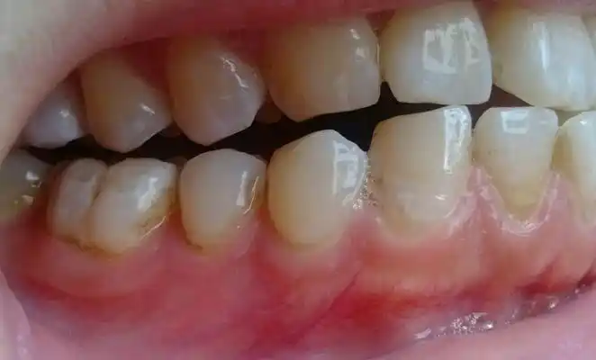 牙釉质损伤图片 (38)