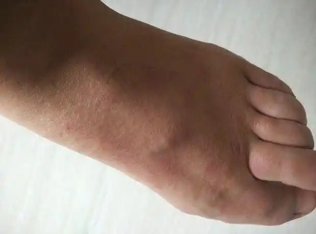 医生说是过敏了,可是打过敏针,吃药还是不管用,该怎么治