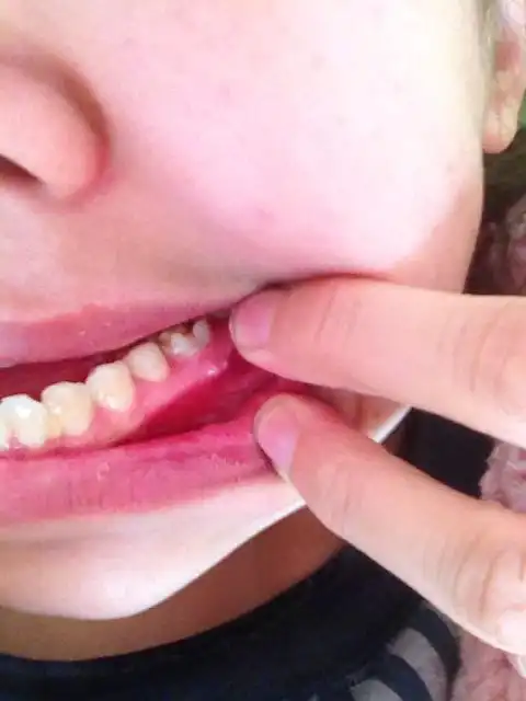 在牙龈上长了个硬疙瘩 有个白色的尖尖 不痛不痒 以前这个牙有补过 这