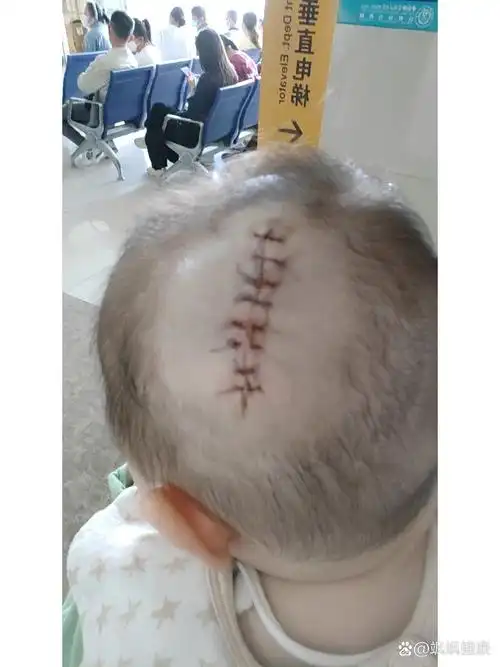 关于皮脂腺痣 我家小老三是生下来头上就有一个指甲盖大小的皮脂腺痣