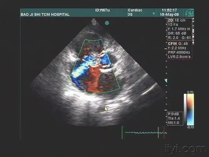 很少见的先心:右冠状动脉右房瘘一例 - 超声医学讨论版 - 爱爱医医学