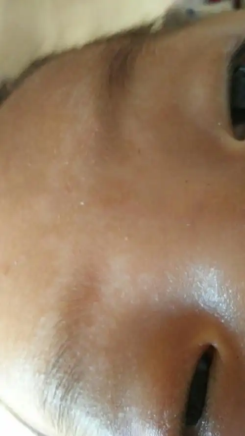 宝宝脸上长了白点