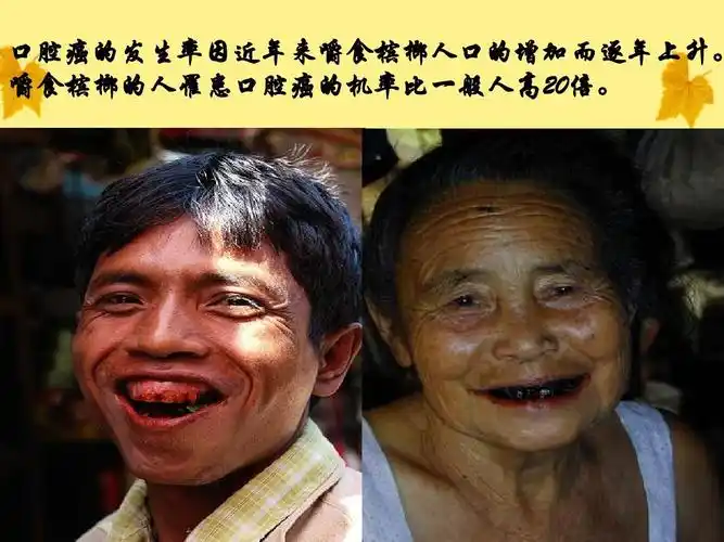 口腔癌的发生率因近年来嚼食槟榔人口的增加而逐年上升.