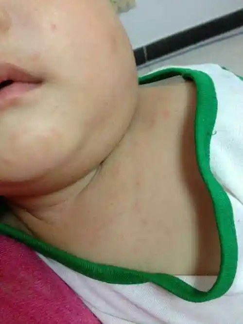 帮忙看看这是幼儿疹子吗?宝宝发烧了两天后起的!