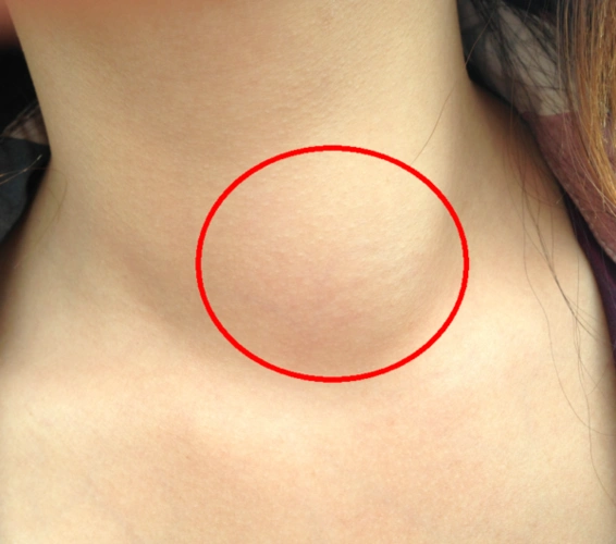 脖子肿大,锁骨上方偏左侧.