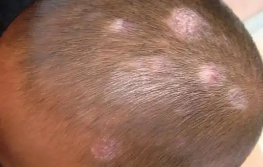 头皮白斑最初期的图片
