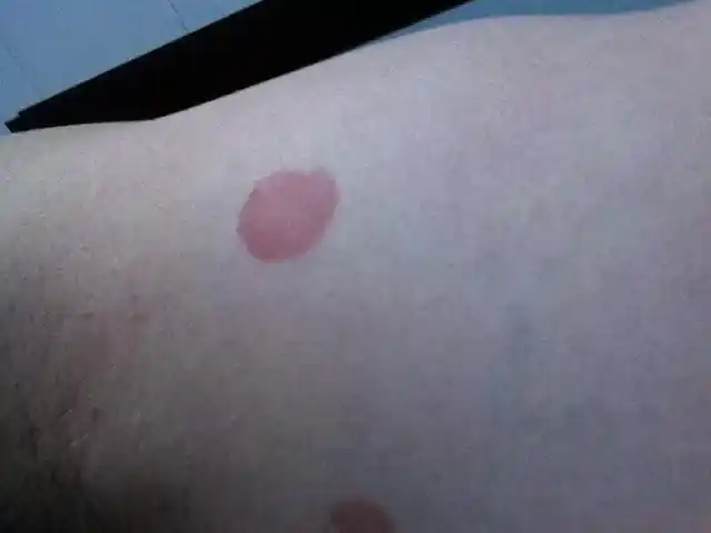 胳肢窝下面出现红斑.以前很淡 现在越来越大 也越来越红了.