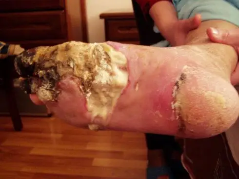 糖尿病足坏疽病例图片