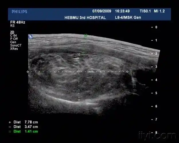 左侧臀部实性肿物--纤维脂肪瘤? - 超声医学讨论版 - 爱爱医医学论坛