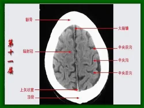 头颅ct解剖图片ppt