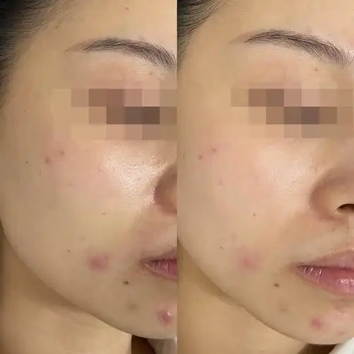 光子嫩肤后如何保养