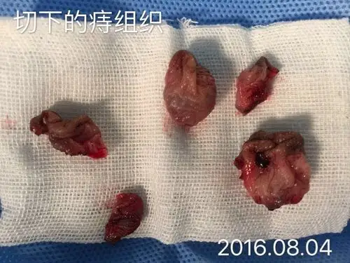 洪女士,38岁,环状混合痔,8月3日入院,8月4日局麻下行外痔电切内痔结扎